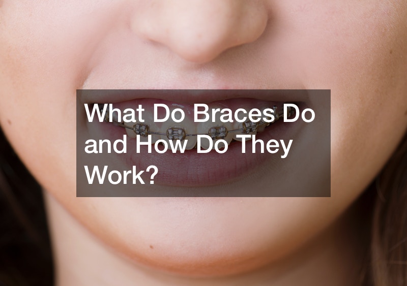 What Do Braces Do and How Do They Work?